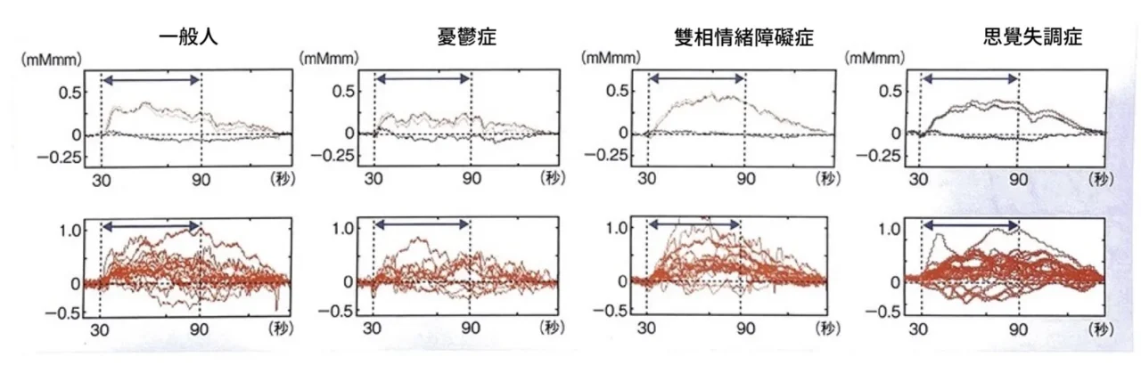 一般人、憂鬱症、躁鬱症（雙相情緒障礙症）與思覺失調症個案NIRS呈現之不同波形¹)