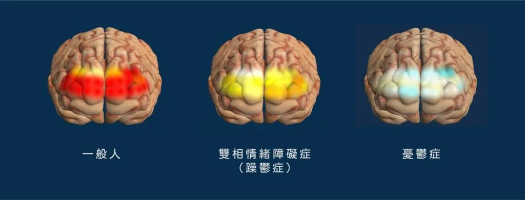 一般人、憂鬱症個案、躁鬱症個案，以NIRS檢測，於開始執行測驗後50秒時的大腦重組影像。紅色表示帶氧腦細胞，藍色表示無法帶氧的腦細胞。可見一般人腦神經運作時，腦細胞可充滿氧氣，躁鬱症個案此能力稍弱，而憂鬱症個案腦細胞更無法帶氧。
