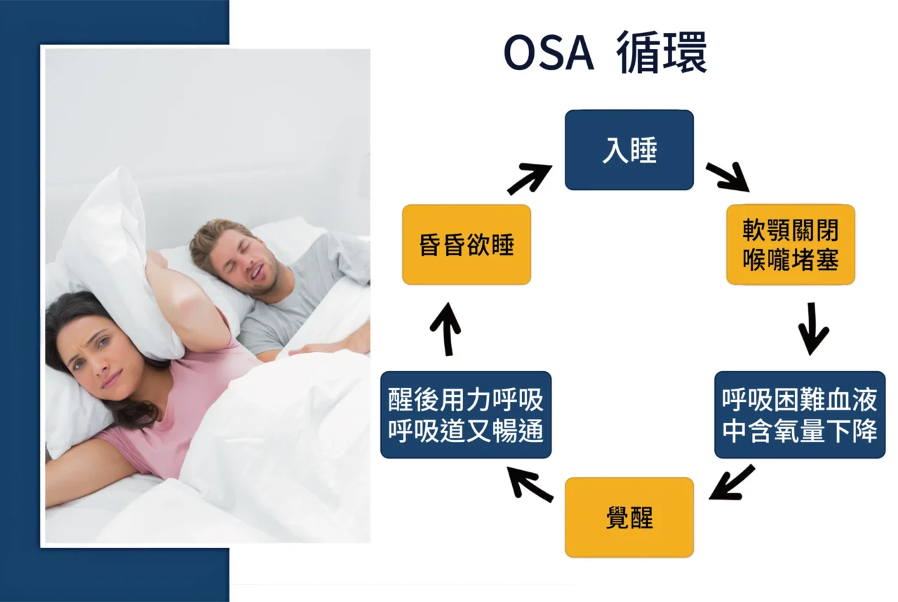 OSA阻塞型睡眠呼吸中止症循環