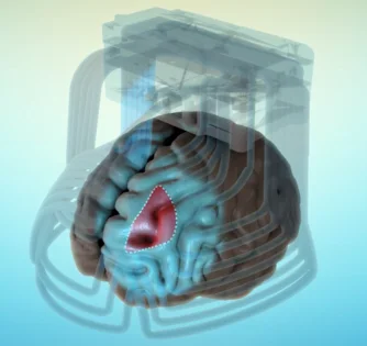 Deep TMS能更完整、更深度刺激背外前額葉DLPFC部分(紅色區域)