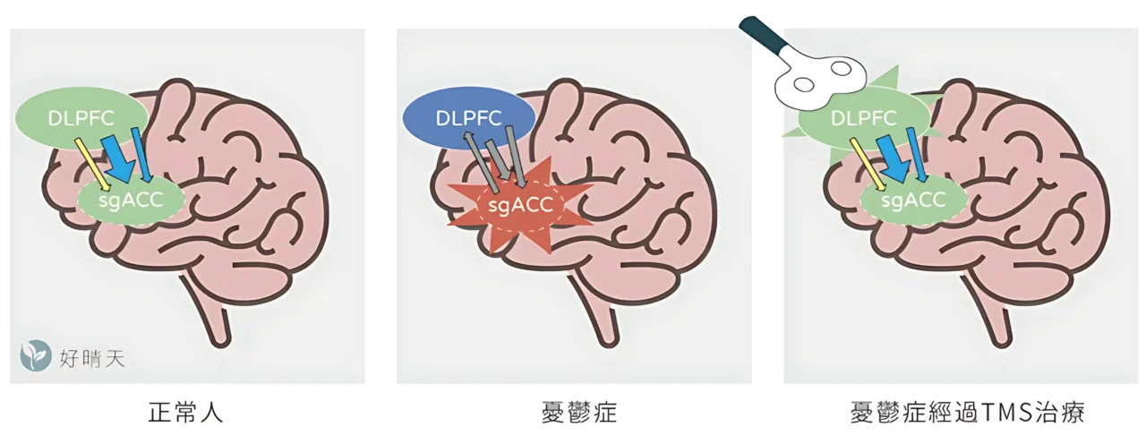 前額葉 (DLPFC) 與膝下前扣帶回 (sgACC) 高度互相連結，正常情況下，DLPFC會抑制sgACC，讓兩個腦區達到穩定的平衡以調控情緒（左圖）。憂鬱症患者sgACC活性過高，但DLPFC活性低下，雙方調節紊亂，造成情緒及認知影響（中圖）。憂鬱症患者經過TMS治療後，DLPFC活性提升，可正常抑制sgACC，雙方連結重新達到平衡使情緒穩定（右圖）。